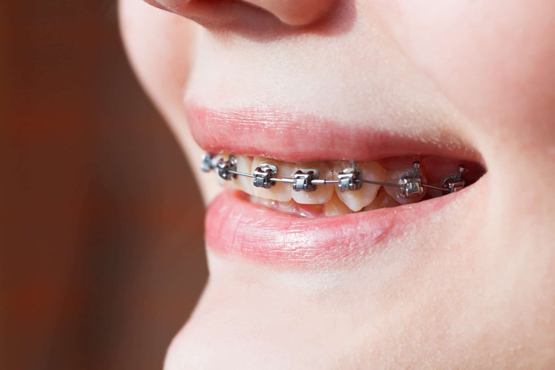 side view of dental braces on teeth